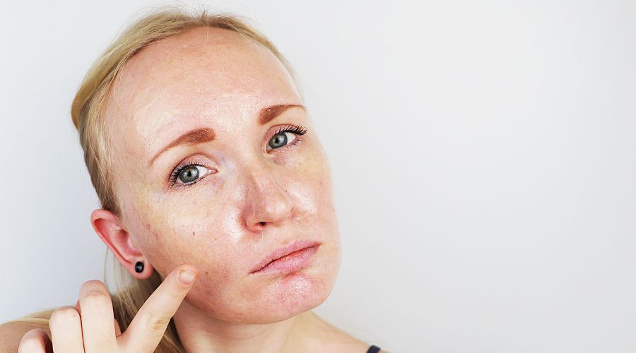 What Causes Oily Skin
